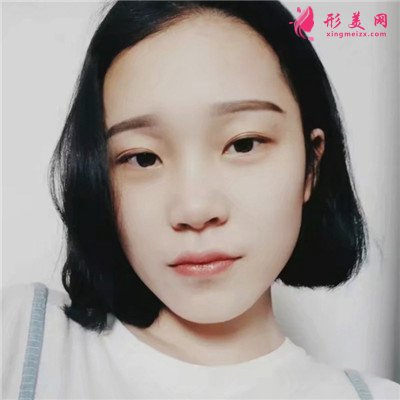 成都小仙女全切雙眼皮手術(shù)術(shù)后效果對比