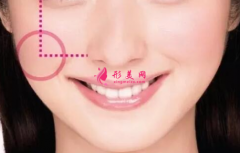 自體脂肪填充臉部會(huì)腫多久？