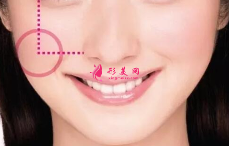 自體脂肪填充臉部會(huì)腫多久