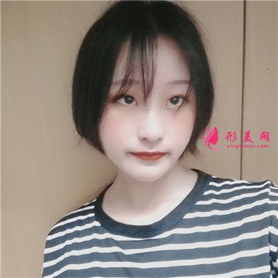 深圳內切祛眼袋術后恢復情況對
