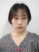 深圳鵬程醫(yī)院內(nèi)切祛眼袋術(shù)后恢復(fù)情況對
