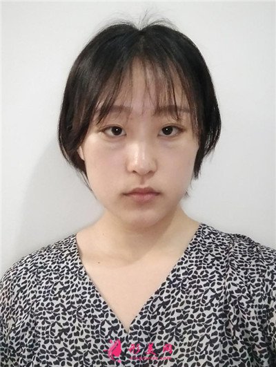深圳內切祛眼袋術后恢復情況對