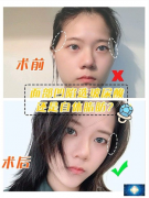 北京韓嘯院長(zhǎng)全臉脂肪案例，面部凹陷選玻尿酸還是自體脂肪？