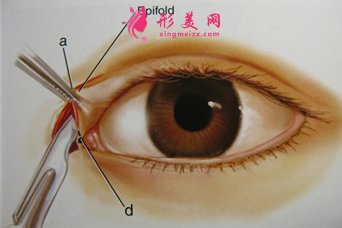 開眼角的價格費用是多少