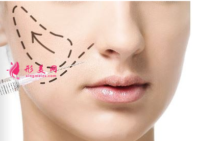 玻尿酸填充臉部?jī)r(jià)格費(fèi)用是多少