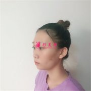 鄭州大學(xué)第二附屬醫(yī)院彩光嫩膚術(shù)后恢復(fù)效果展示
