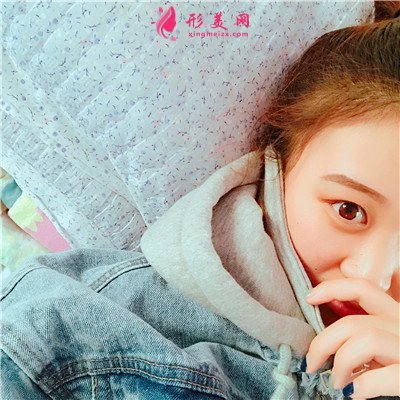 河南彩光嫩膚術(shù)后恢復(fù)效果展示