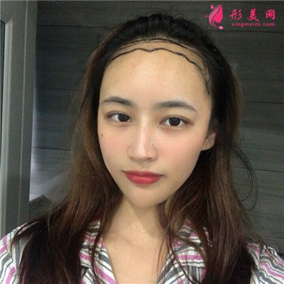 重慶種植發(fā)際線手術(shù)術(shù)后效果分享