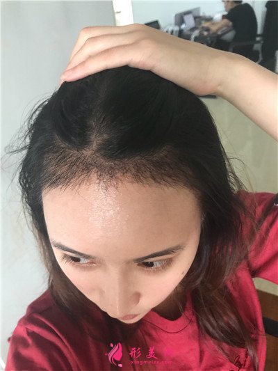 重慶種植發(fā)際線手術(shù)術(shù)后效果分享