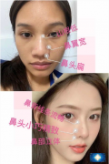 重慶軍美董志勇醫(yī)生做的初鼻，隆鼻一個月，輕松hold住側(cè)顏殺