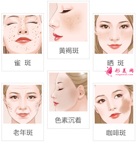 激光祛斑什么時(shí)候可以化妝