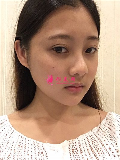 鄭州吸脂瘦臉手術術后效果對比