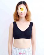 北京麗都整形醫(yī)院假體隆胸案例 從A變C的喜悅您能體會(huì)嗎？