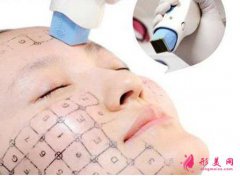 熱瑪吉一次多少錢?原理是什么?