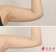 手臂吸脂多久恢復(fù)?手臂抽脂需要多久才能恢復(fù)?