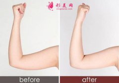 吸脂術(shù)后手臂疼痛的八個(gè)注意事項(xiàng)