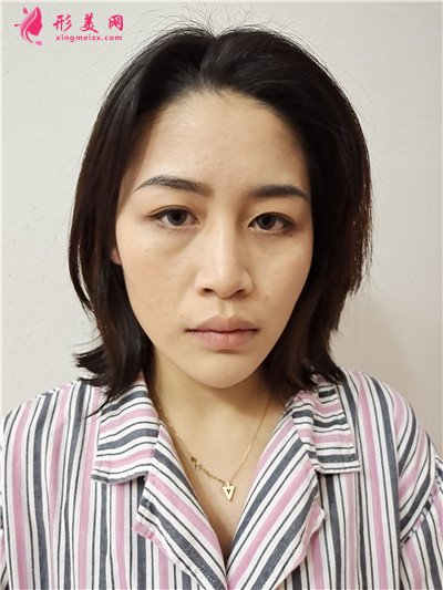 鄭州耳軟骨隆鼻術(shù)后恢復(fù)情況對(duì)比分享