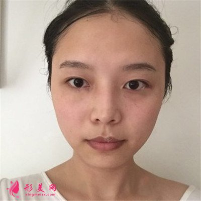 成都全切雙眼皮術(shù)后恢復(fù)情況對比分享