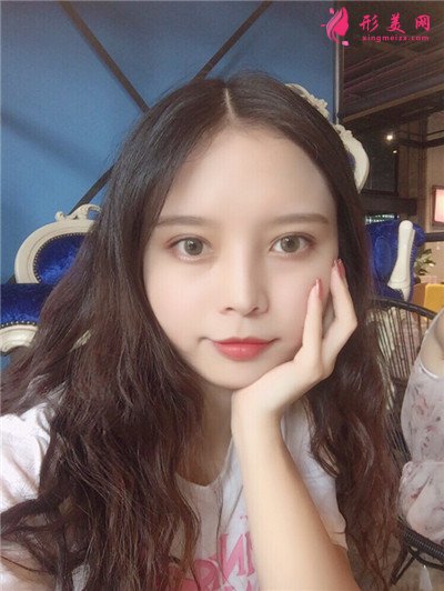 成都全切雙眼皮術(shù)后恢復(fù)情況對比分享