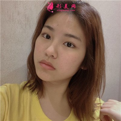 成都小姐姐面部吸脂術(shù)后恢復(fù)情況分享