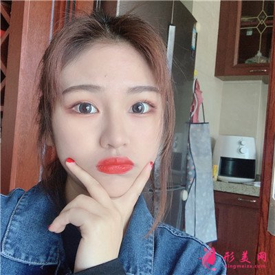 成都小姐姐面部吸脂術(shù)后恢復(fù)情況分享