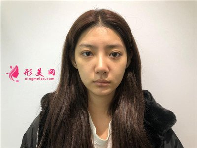 深圳硅膠假體隆鼻術后恢復效果反饋