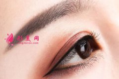 全切雙眼皮手術(shù)的效果自然嗎