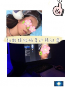 寧波藝星葉廣浩醫(yī)生做的提拉抗初老，熱拉提plus后期恢復(fù)！