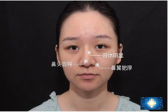 廣州廣大整形美容醫(yī)院做的隆鼻修復(fù)案例，這是第3次做鼻子了