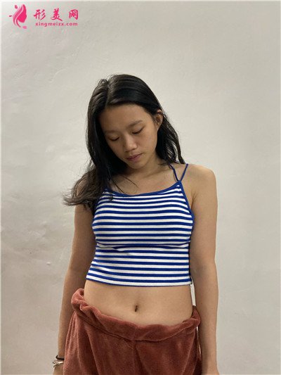 深圳腰腹吸脂術(shù)后小姐姐恢復(fù)情況反饋