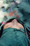 長(zhǎng)沙貝美醫(yī)療美容肋軟骨隆鼻術(shù)后恢復(fù)情況展示