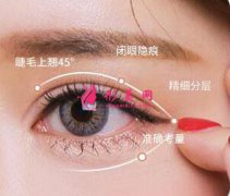 切開雙眼皮恢復(fù)期一般是多久？