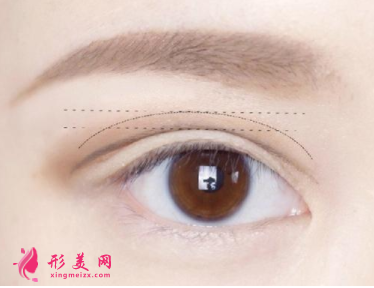 切開雙眼皮恢復(fù)期一般是多久