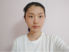 北京純脂醫(yī)療美容自體脂肪填充全臉怎么樣？