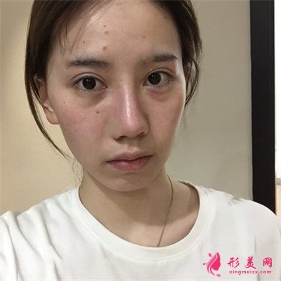 杭州膨體隆鼻術(shù)后案例分享