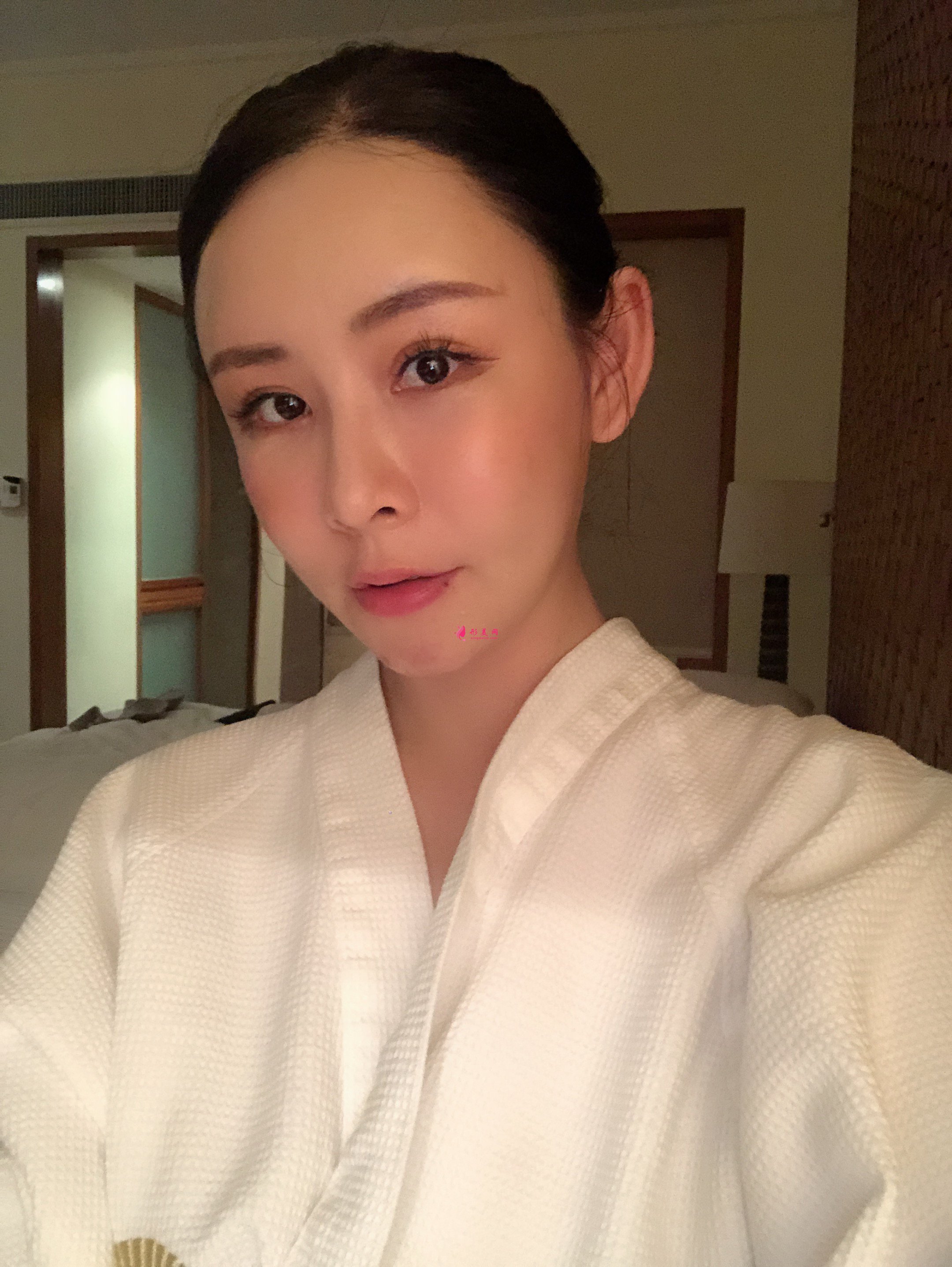 上海美萊醫(yī)療美容價(jià)格表，附自體脂肪豐額頭案例分享