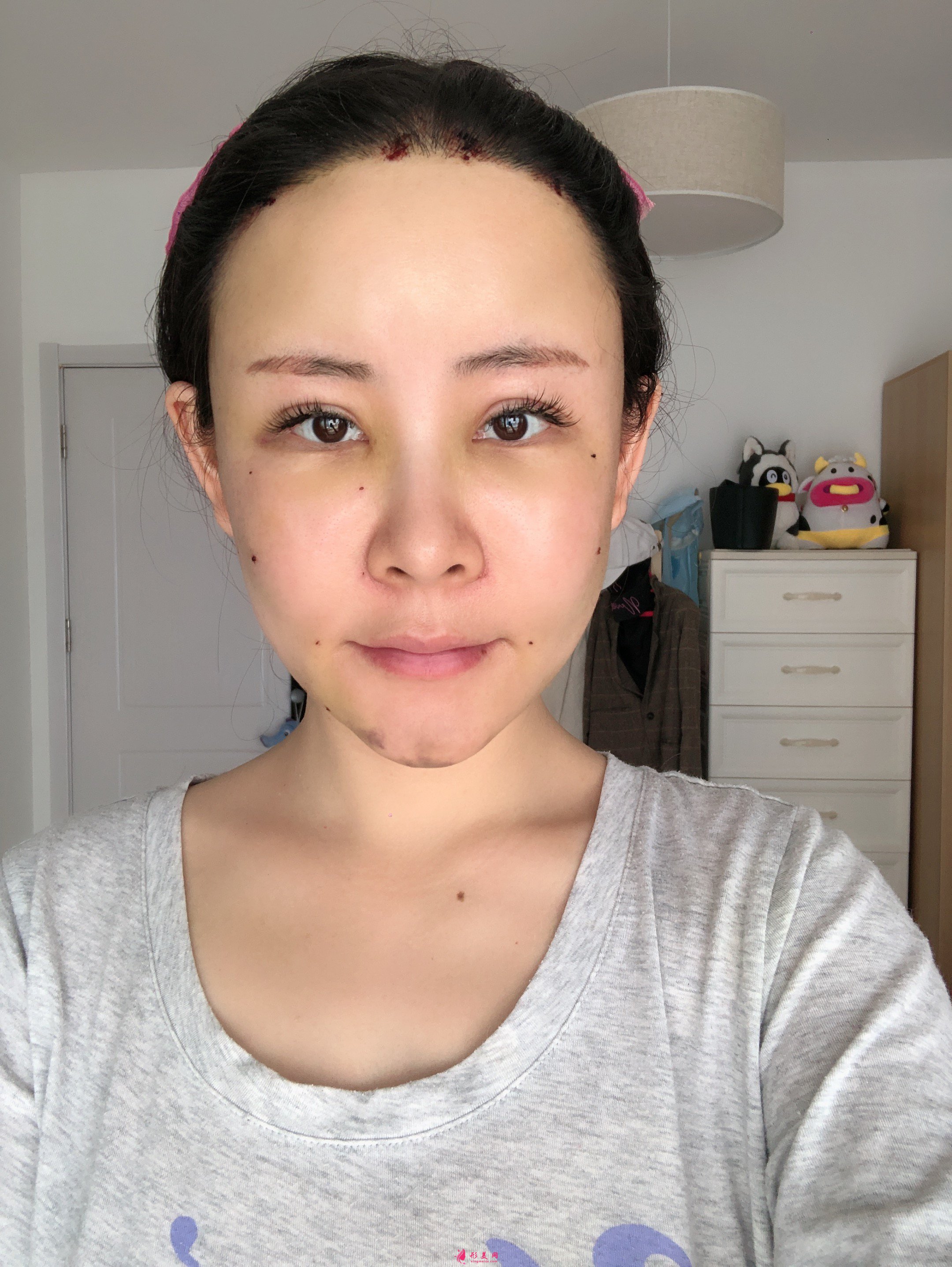 上海美萊醫(yī)療美容價(jià)格表，附自體脂肪豐額頭案例分享