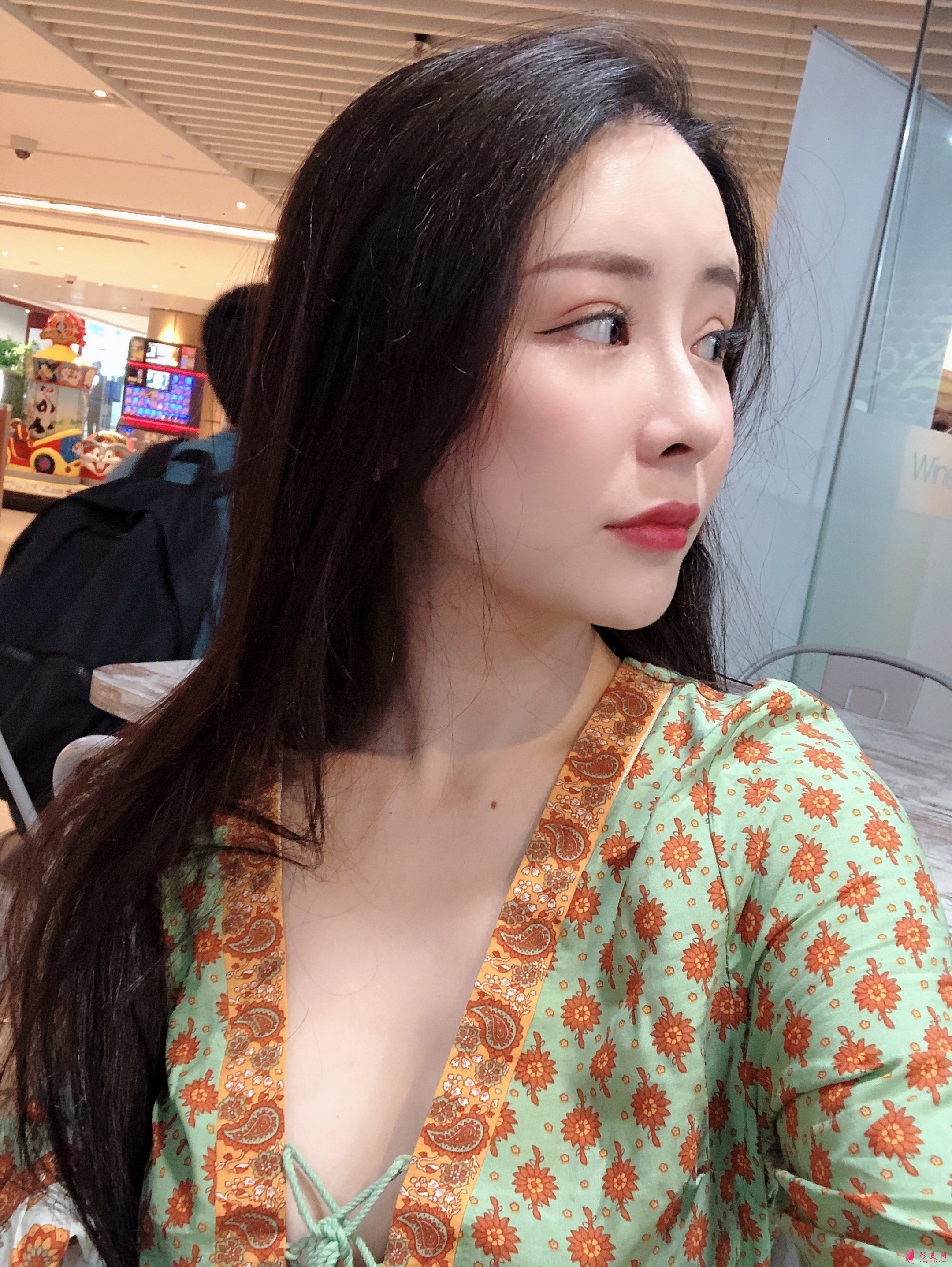 上海美萊醫(yī)療美容價(jià)格表，附自體脂肪豐額頭案例分享