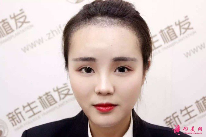 杭州新生植發(fā)價(jià)格表。附植發(fā)案例