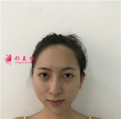 南京種植發(fā)際線術后恢復情況對比