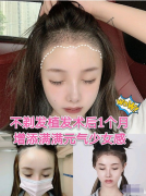 上海新生植發(fā)做的發(fā)際線移植，發(fā)際線是很多女神都有的問(wèn)題哦