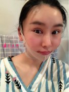 上海九院張詩雷正頜怎么樣?真實案例和醫(yī)生個人資料分享~
