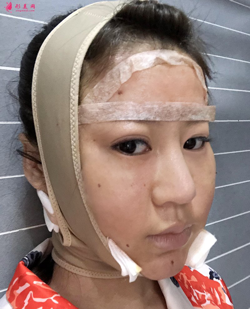 上海自體脂肪面部填充前后對比圖