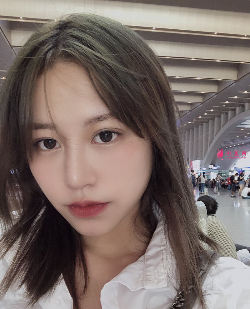 上海自體脂肪面部填充前后對比圖