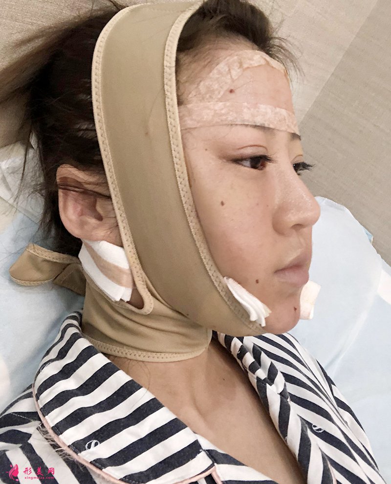 上海自體脂肪面部填充前后對比圖
