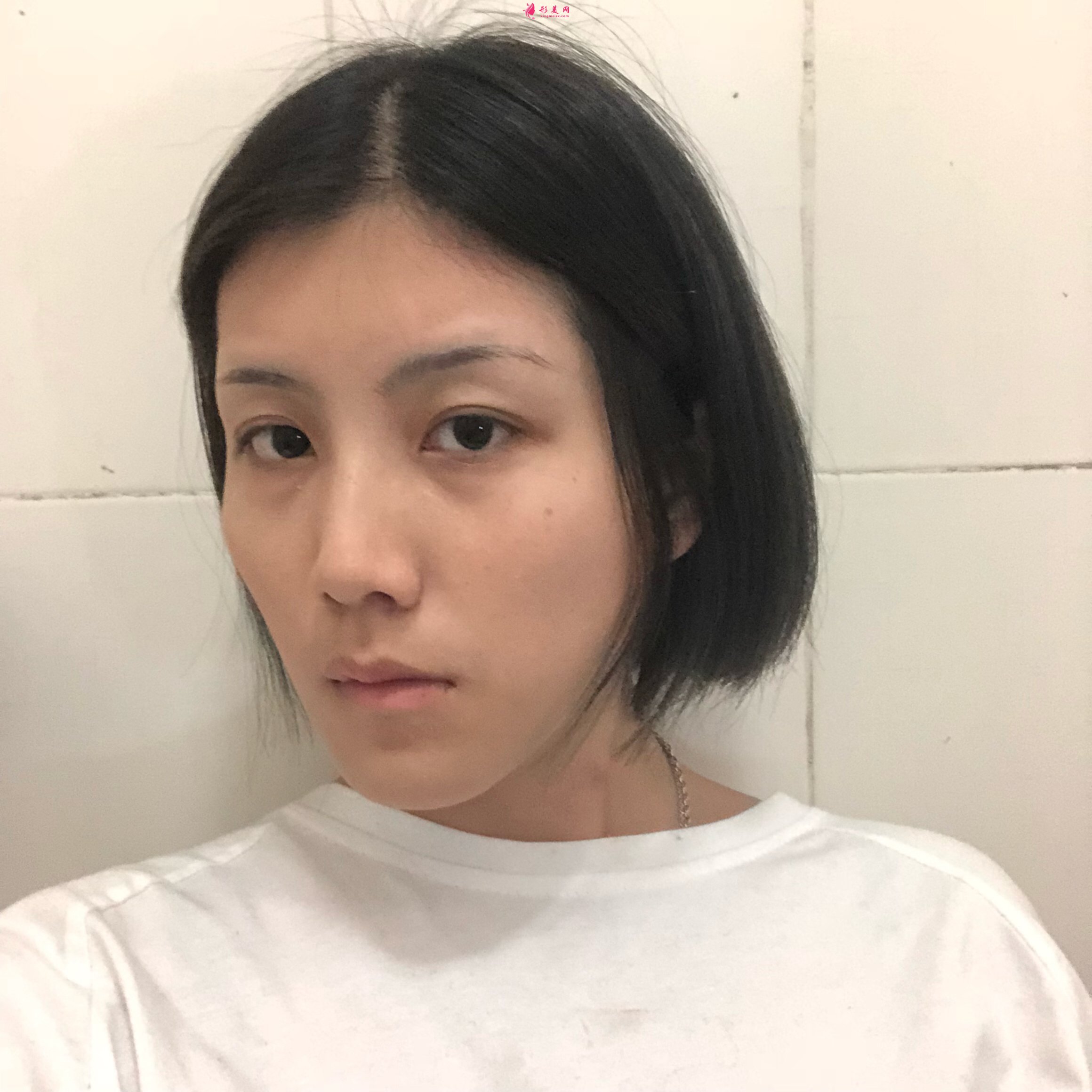 成都美綻美整形醫(yī)院何一波做面部填充怎么樣？