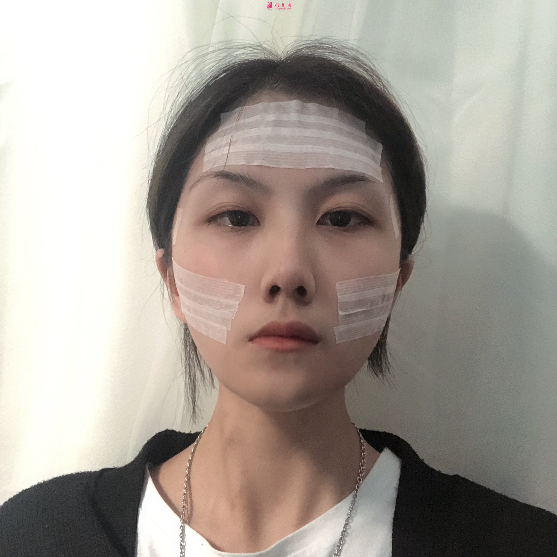 成都美綻美整形醫(yī)院何一波做面部填充怎么樣？