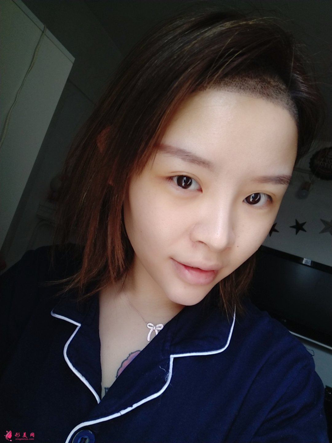植發(fā)的效果能保持多久？