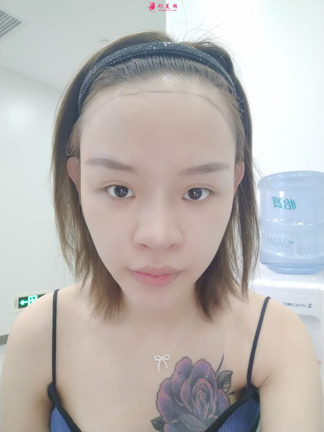 植發(fā)的效果能保持多久？