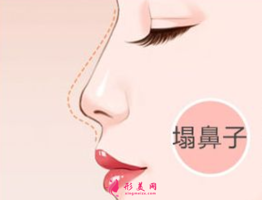 達拉斯隆鼻大概需要多少錢